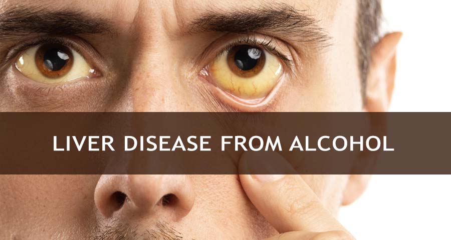 Alcohol and Liver Disease
