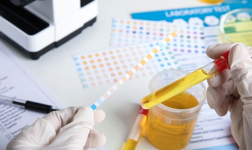 Doctor holding test tube with urine sample for hydrocodone drug test.