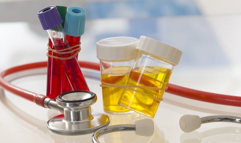 Urine samples and blood samples prepared for tramadol drug test.